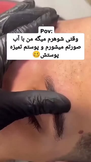 چسب بینی لانبنا کاسه ای ضدجوش سرسیاه